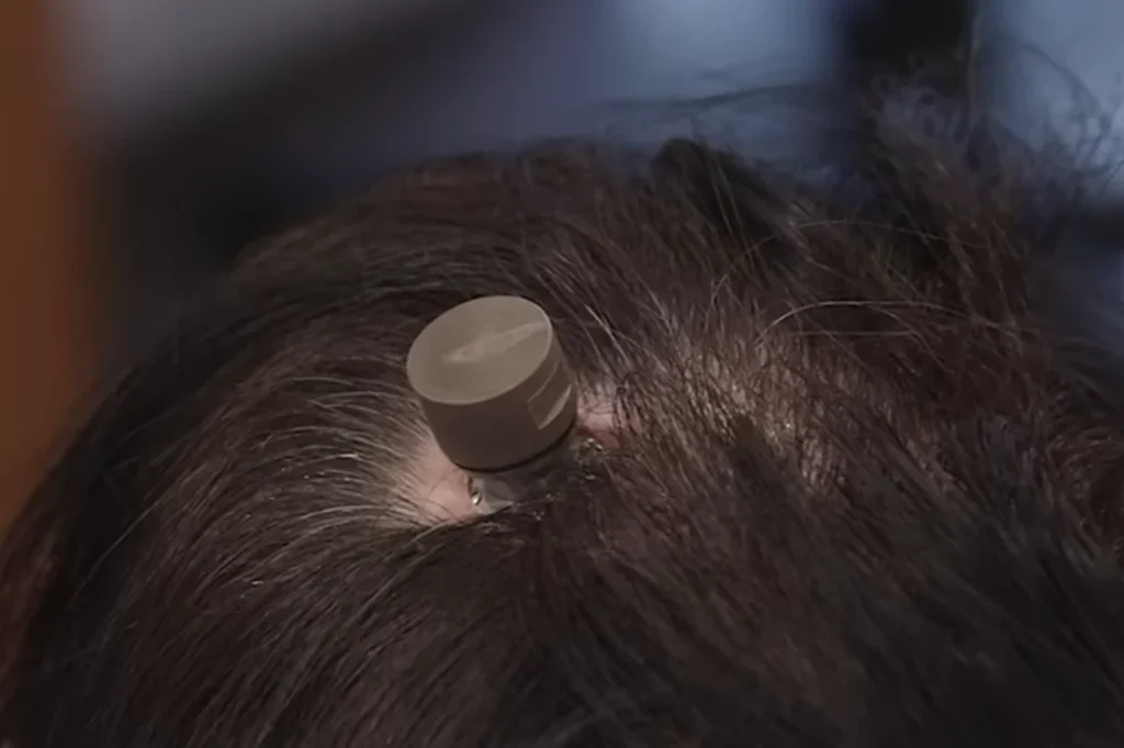 neuralink brain chip after implant on brain